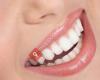 Teeth Whitening Northern Ireland